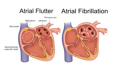 flutter or flatter|Flatter vs Flutter .